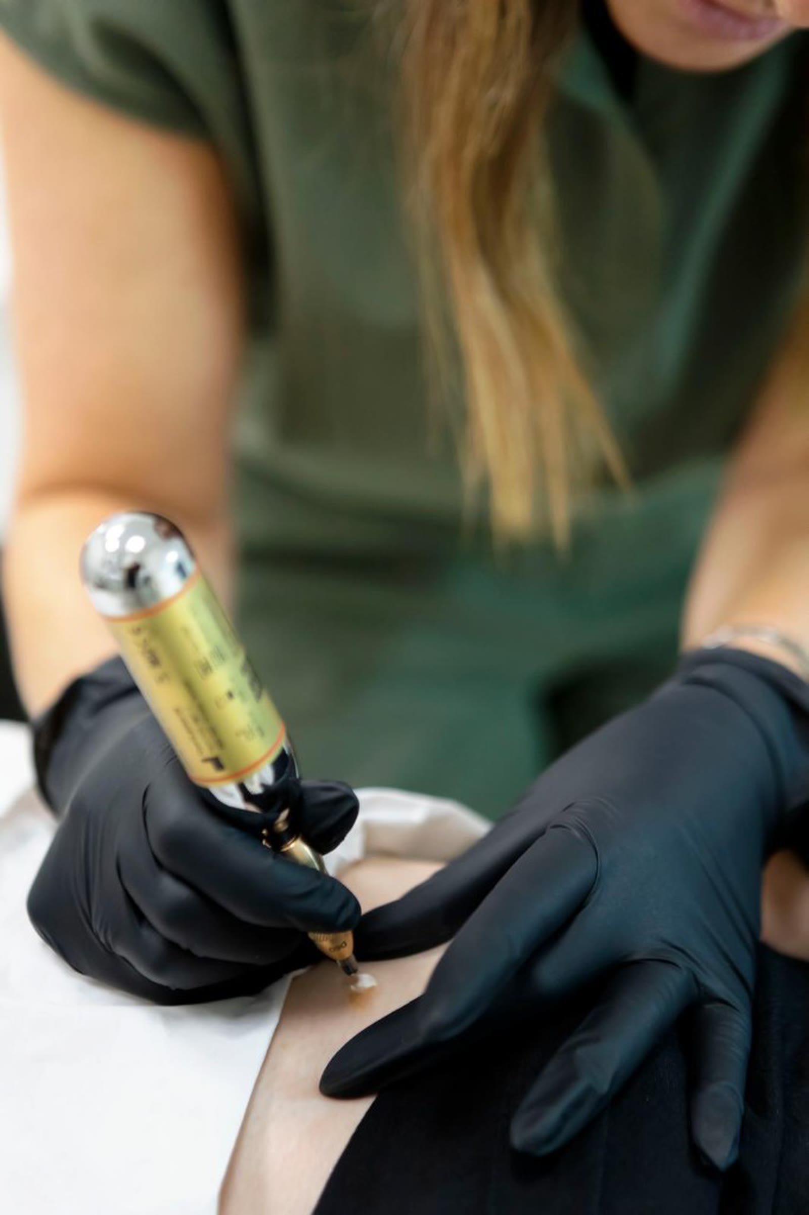 Cryotherapy pen in use