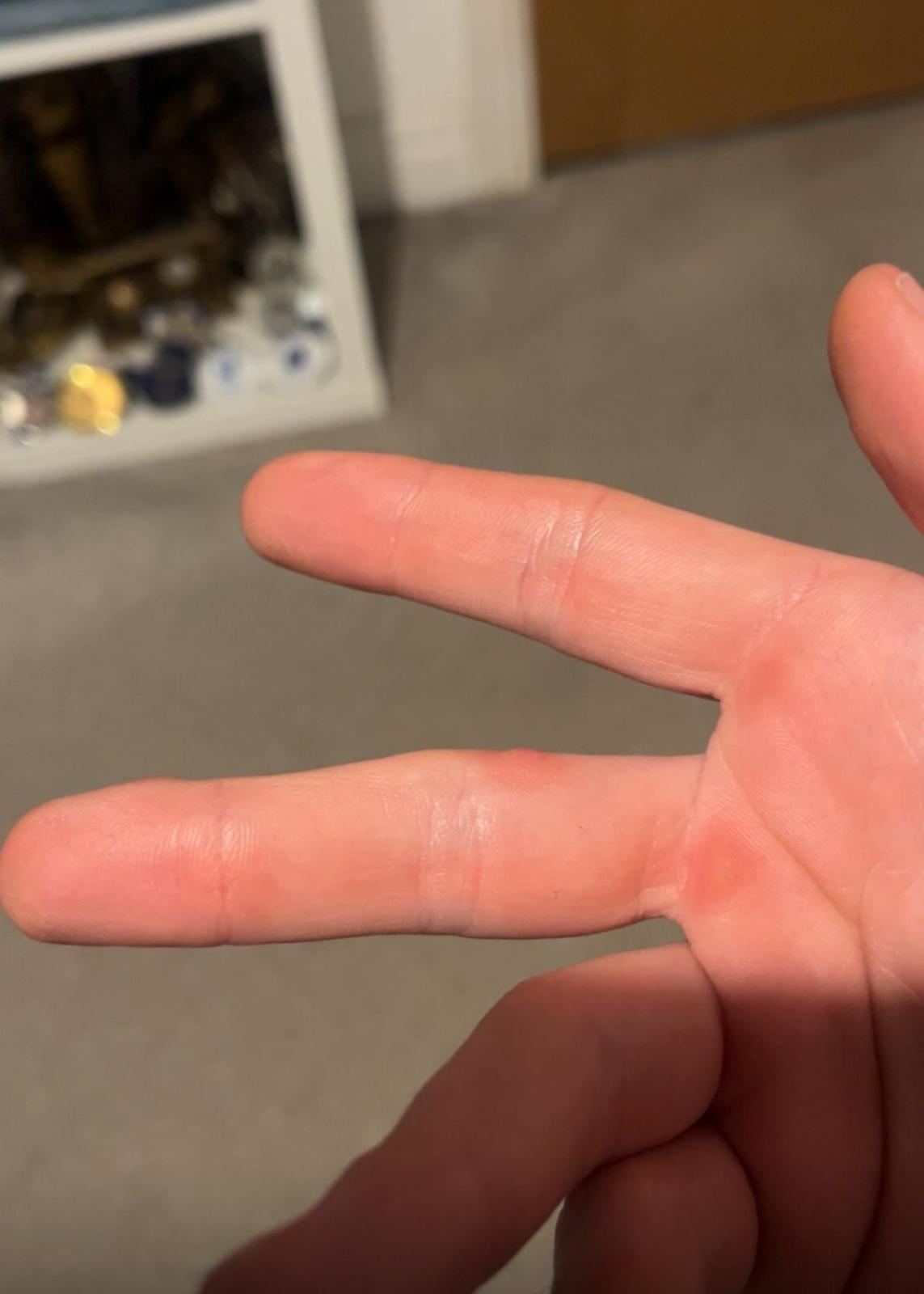 Index finger after second cryotherapy session, lesion resolved