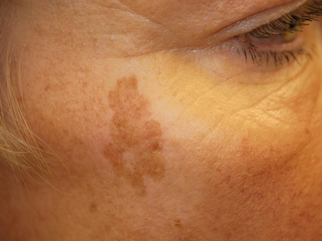 Age spots on facial skin showing typical brown pigmented patches